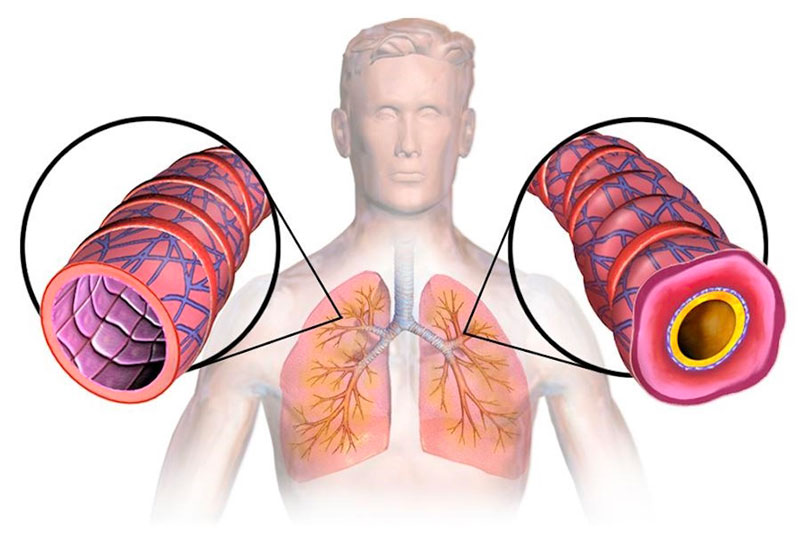 Co thắt phế quản có tác động không tốt đến việc hít thở